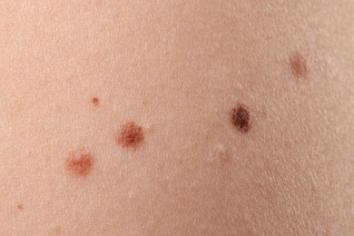 Photo of Woman with moles on her body, closeup