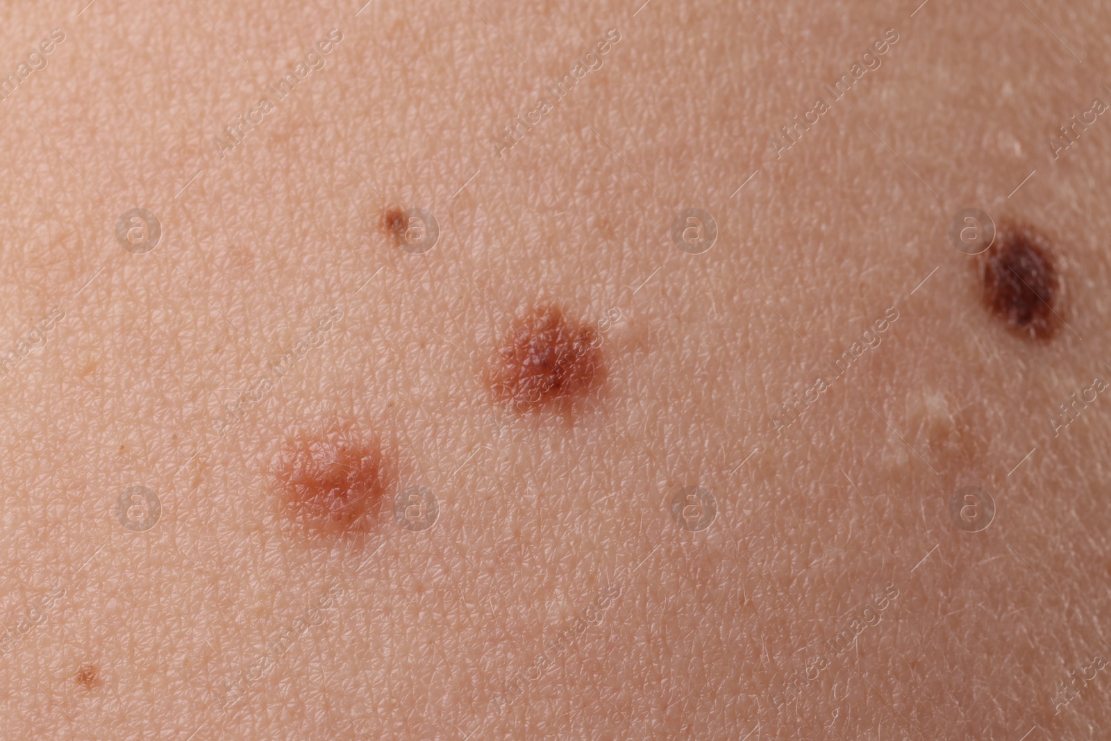 Woman with moles on her body, closeup Photo of Woman with moles on her body, closeup