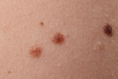 Photo of Woman with moles on her body, closeup