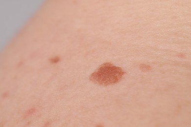 Photo of Woman with moles on her body against light background, closeup