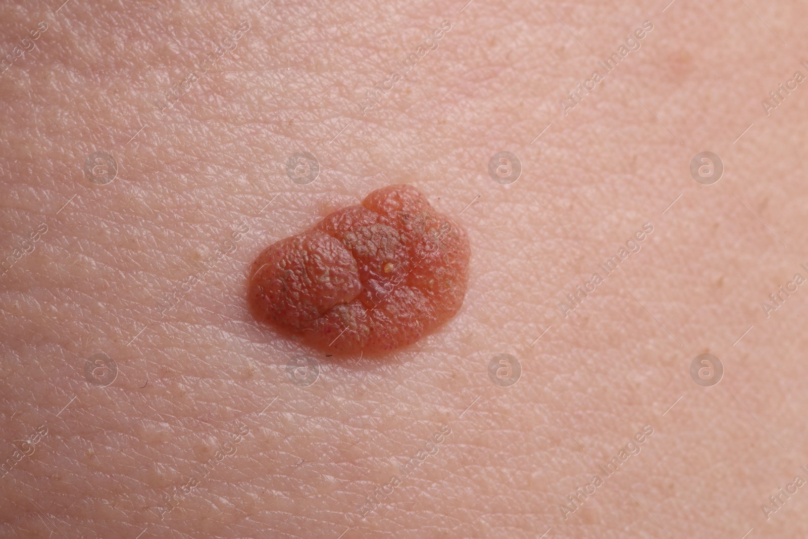 Photo of Woman with mole on her body, closeup
