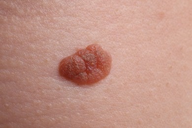 Photo of Woman with mole on her body, closeup