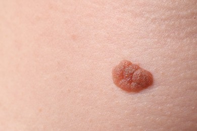 Photo of Woman with mole on her body, closeup