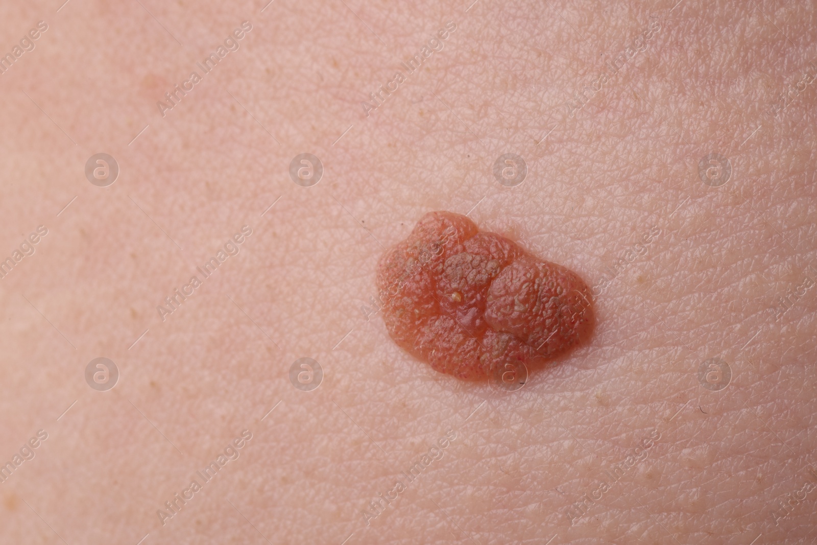 Photo of Woman with mole on her body, closeup