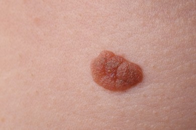Photo of Woman with mole on her body, closeup