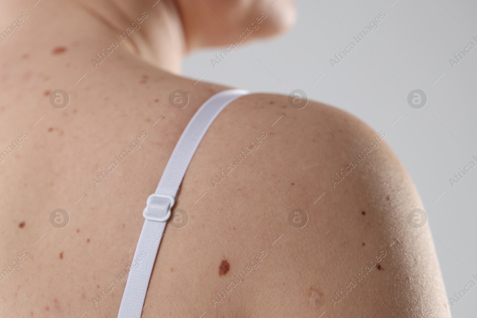 Woman with moles on her body against light background, closeup Photo of Woman with moles on her body against light background, closeup