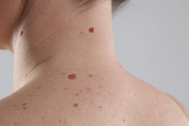 Photo of Woman with moles on her body against light background, closeup