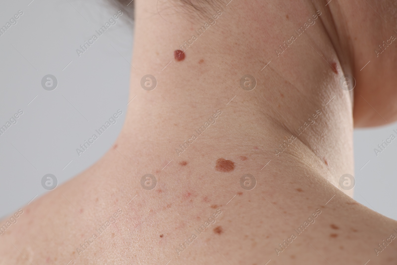 Woman with moles on her body against light background, closeup Photo of Woman with moles on her body against light background, closeup