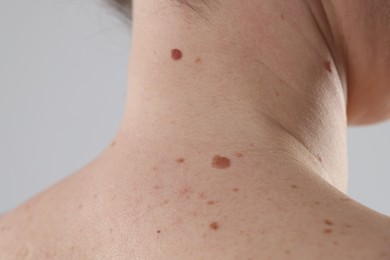 Photo of Woman with moles on her body against light background, closeup