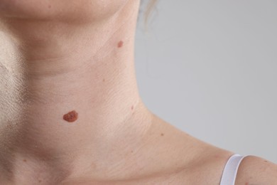 Photo of Woman with moles on her body against light background, closeup. Space for text