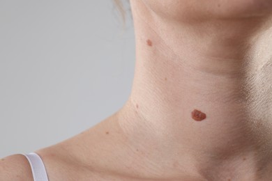 Photo of Woman with moles on her body against light background, closeup. Space for text