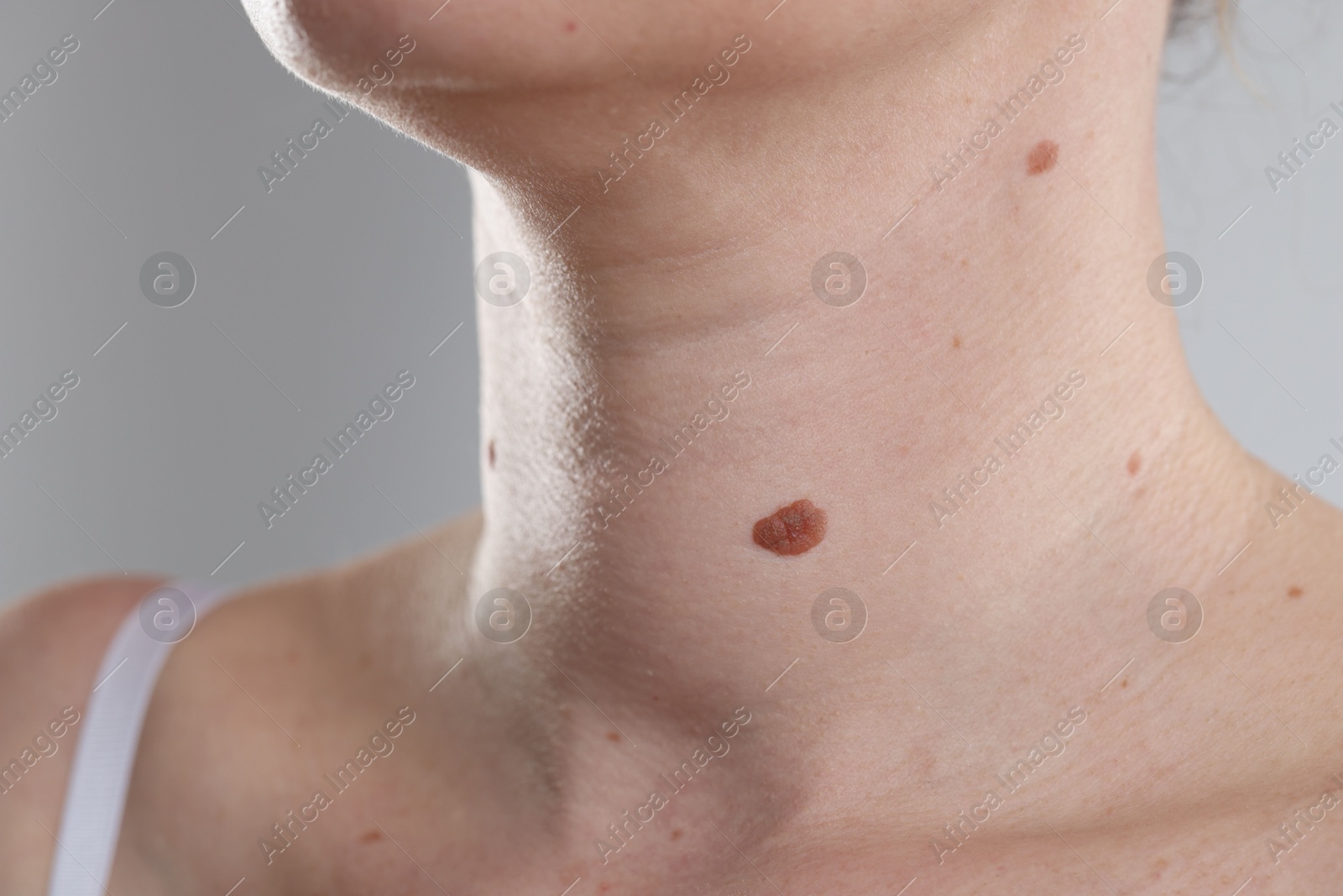 Woman with moles on her body against light background, closeup Photo of Woman with moles on her body against light background, closeup