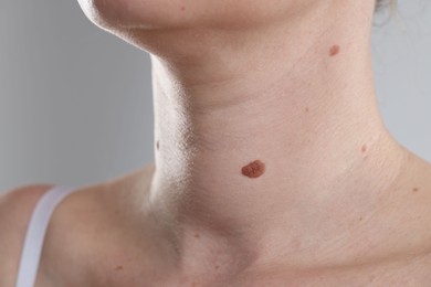 Photo of Woman with moles on her body against light background, closeup