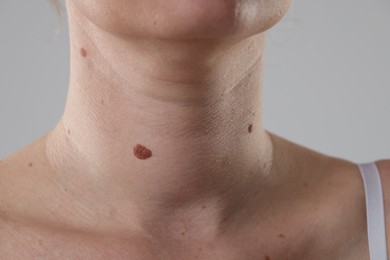 Photo of Woman with moles on her body against light background, closeup