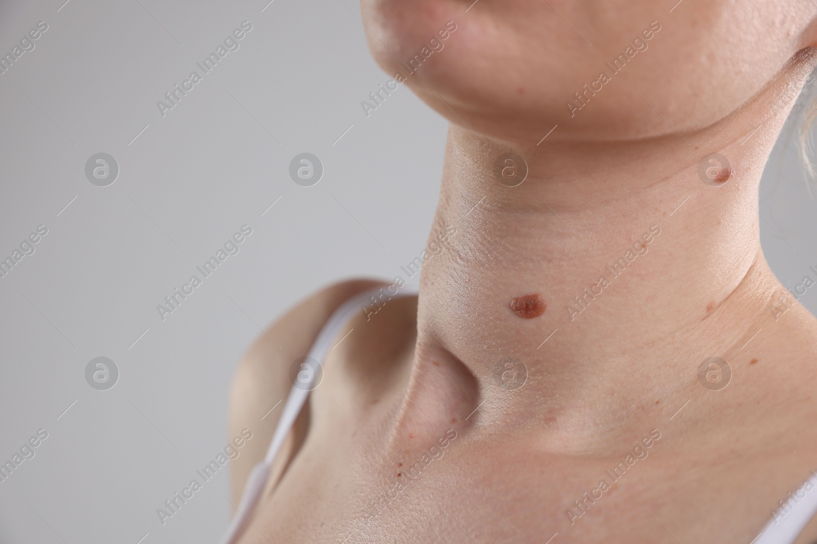 Woman with moles on her body against light background, closeup. Space for text Photo of Woman with moles on her body against light background, closeup. Space for text