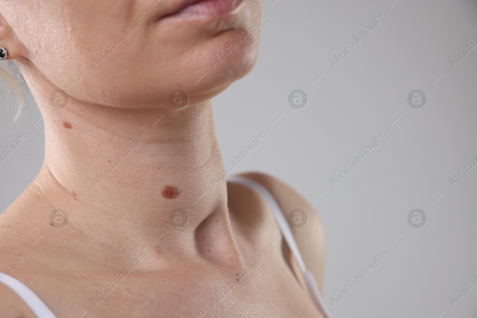 Woman with moles on her body against light background, closeup. Space for text Photo of Woman with moles on her body against light background, closeup. Space for text