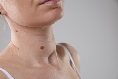 Photo of Woman with moles on her body against light background, closeup. Space for text