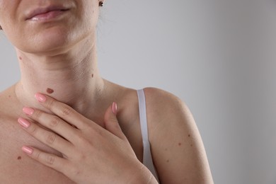 Photo of Woman with moles on her body against light background, closeup. Space for text