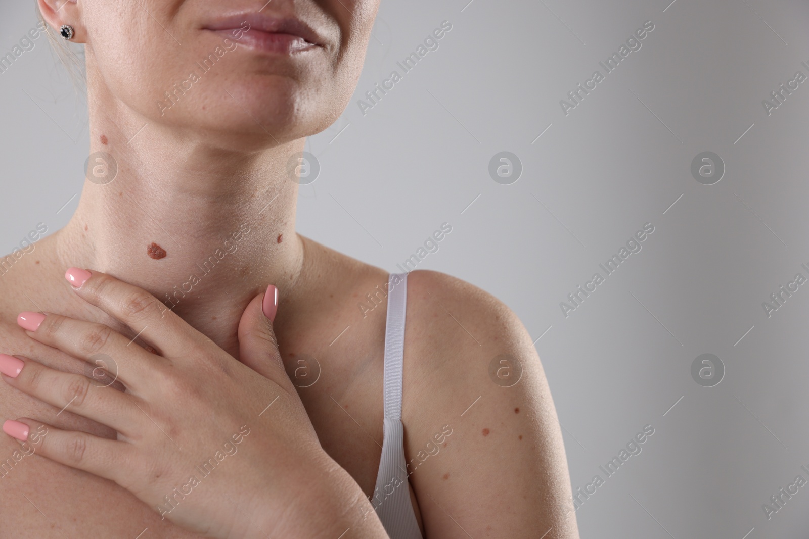 Woman with moles on her body against light background, closeup. Space for text Photo of Woman with moles on her body against light background, closeup. Space for text