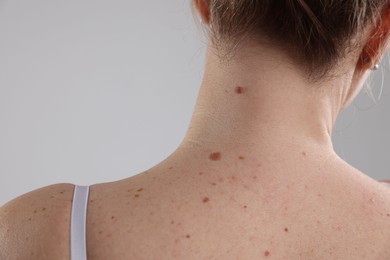 Photo of Woman with moles on her body against light background, closeup