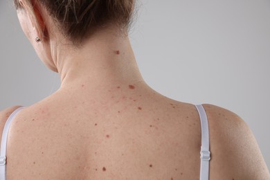Photo of Woman with moles on her body against light background, closeup