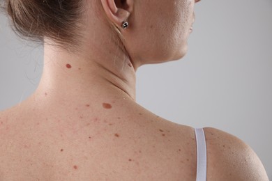 Photo of Woman with moles on her body against light background, closeup