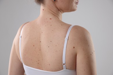 Photo of Woman with moles on her body against light background, closeup