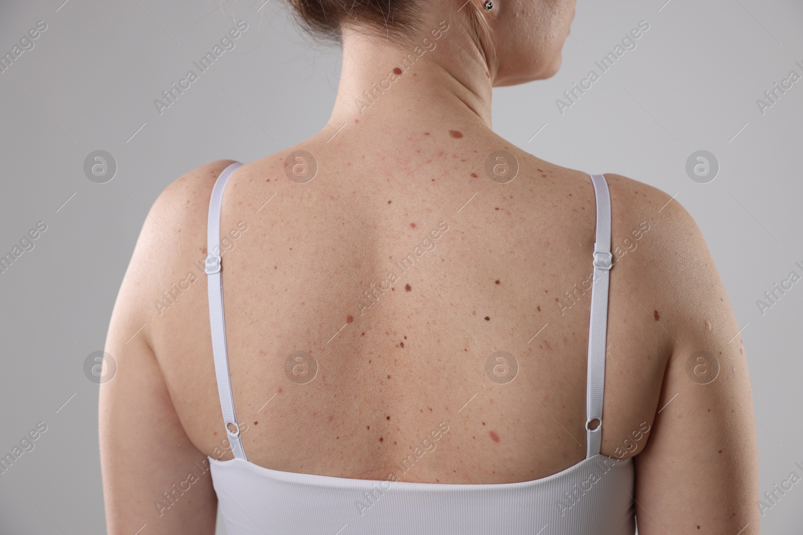 Woman with moles on her body against light background, closeup Photo of Woman with moles on her body against light background, closeup