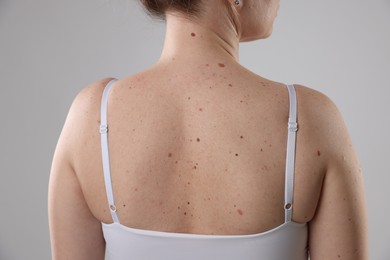 Photo of Woman with moles on her body against light background, closeup