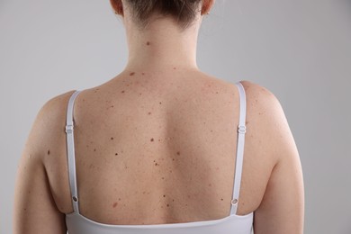 Photo of Woman with moles on her body against light background, closeup