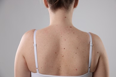 Photo of Woman with moles on her body against light background, closeup