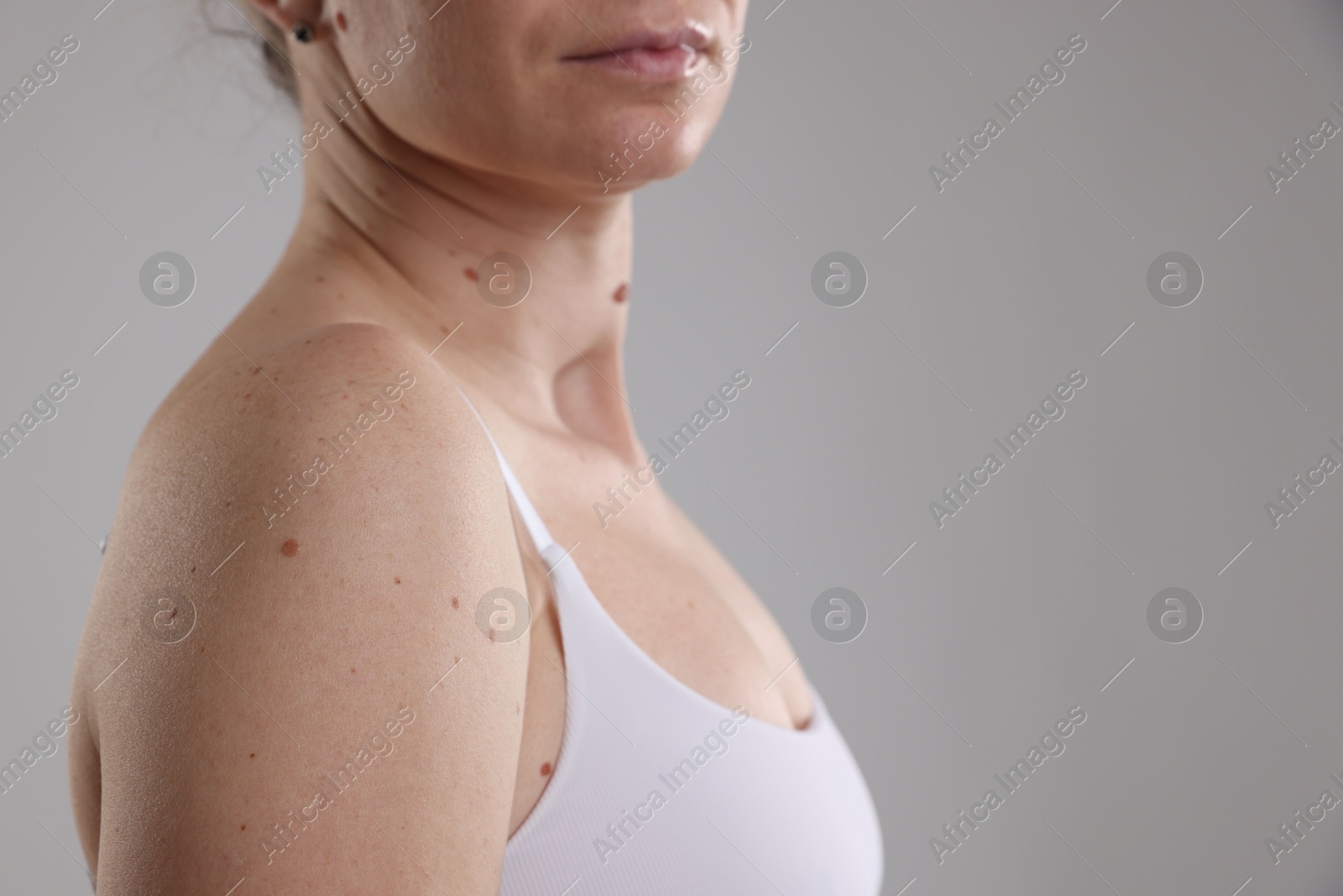 Woman with moles on her body against light background, closeup. Space for text Photo of Woman with moles on her body against light background, closeup. Space for text