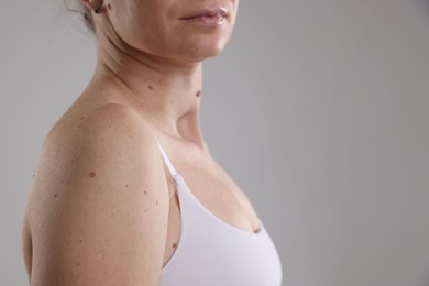 Photo of Woman with moles on her body against light background, closeup. Space for text