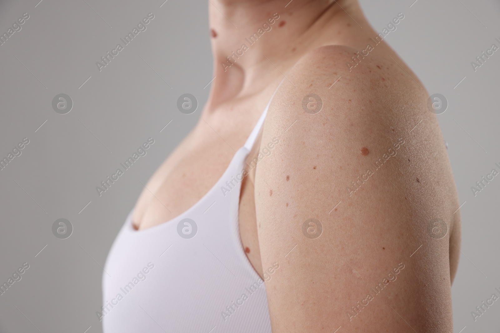 Woman with moles on her body against light background, closeup Photo of Woman with moles on her body against light background, closeup