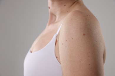 Photo of Woman with moles on her body against light background, closeup