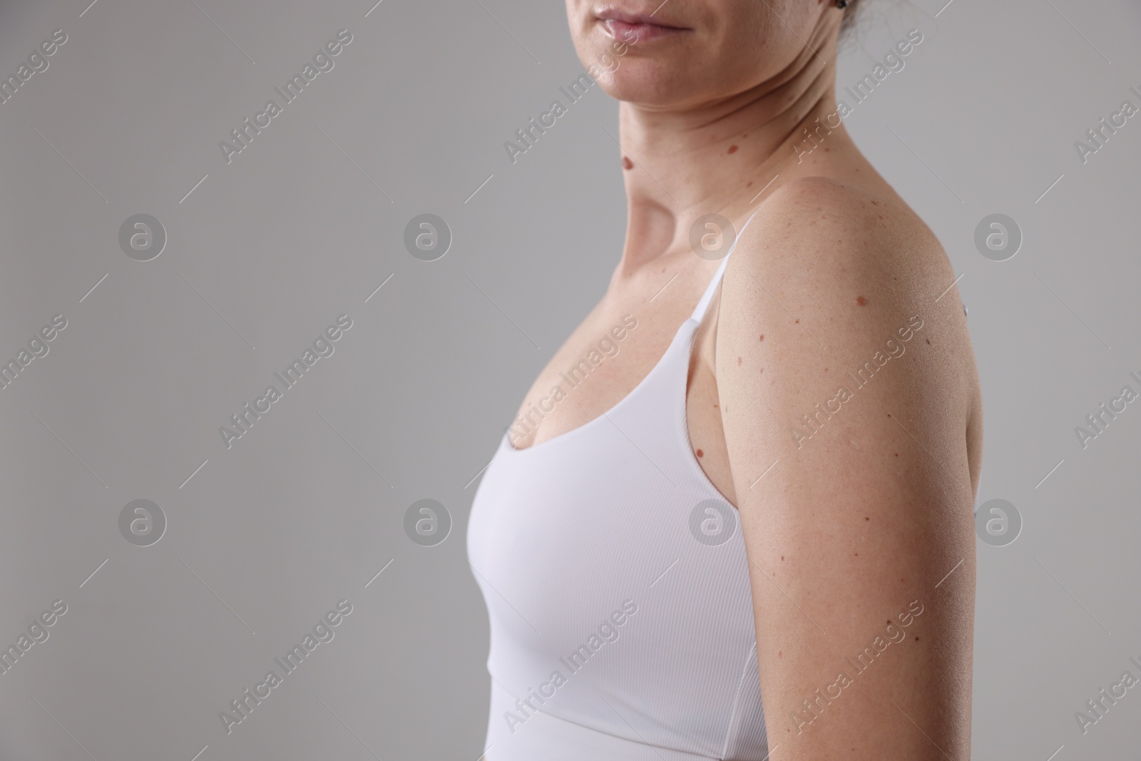 Woman with moles on her body against light background, closeup. Space for text Photo of Woman with moles on her body against light background, closeup. Space for text