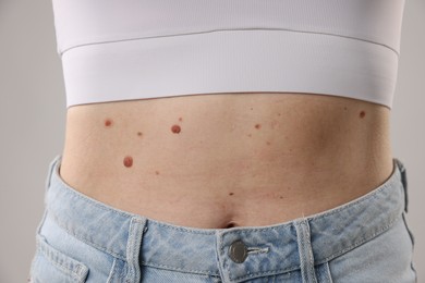 Photo of Woman with moles on her body against light background, closeup