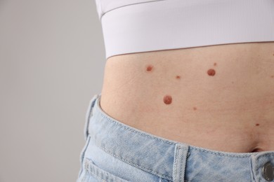 Photo of Woman with moles on her body against light background, closeup