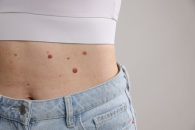 Photo of Woman with moles on her body against light background, closeup