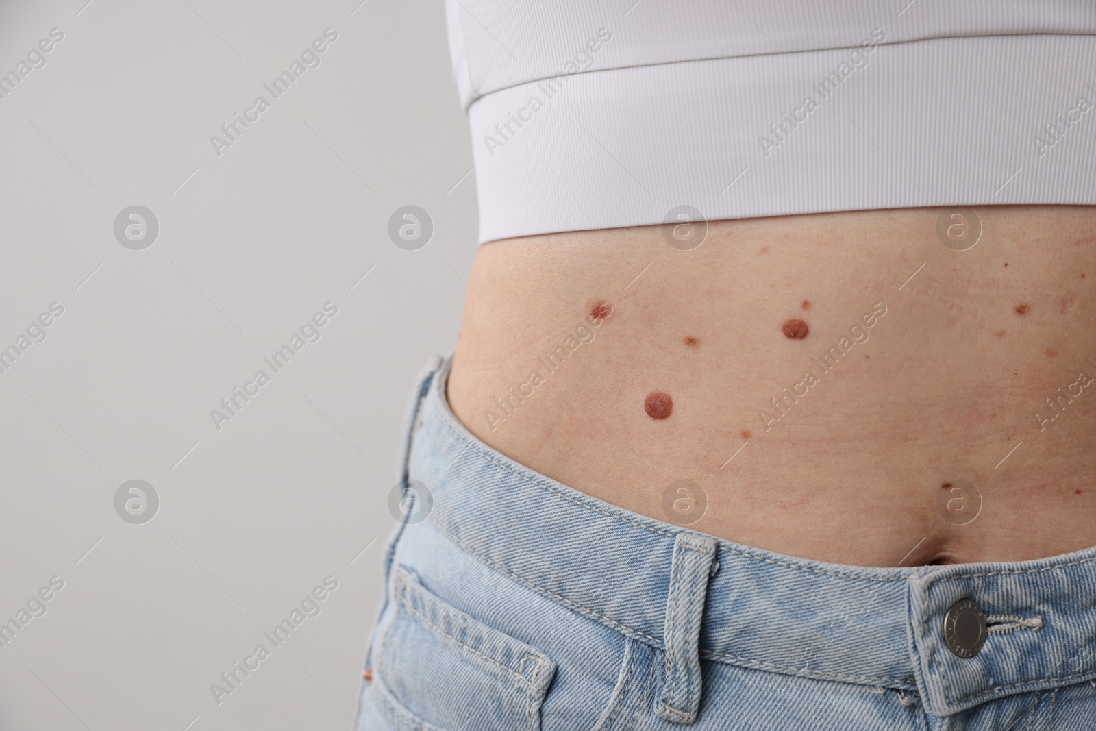 Woman with moles on her body against light background, closeup Photo of Woman with moles on her body against light background, closeup