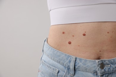 Photo of Woman with moles on her body against light background, closeup
