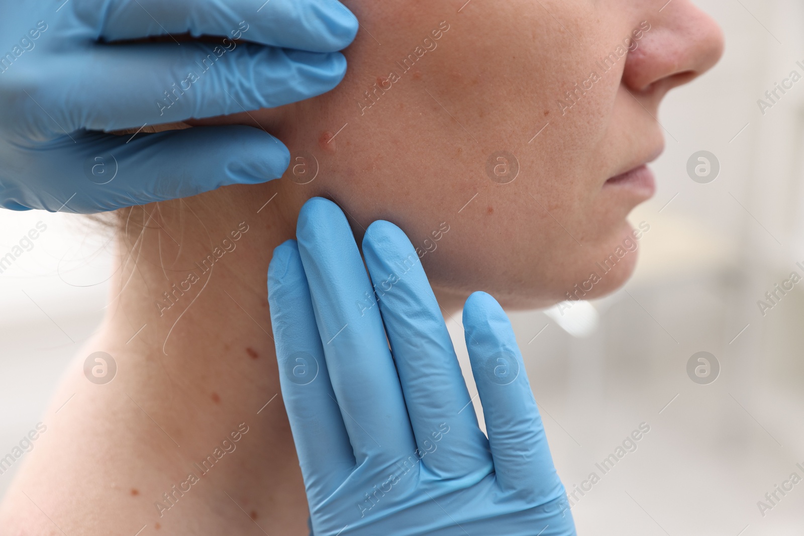 Photo of Doctor examining woman's moles in hospital, closeup