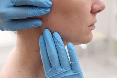 Photo of Doctor examining woman's moles in hospital, closeup