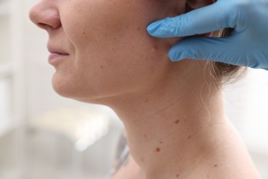 Photo of Doctor examining woman's moles in hospital, closeup