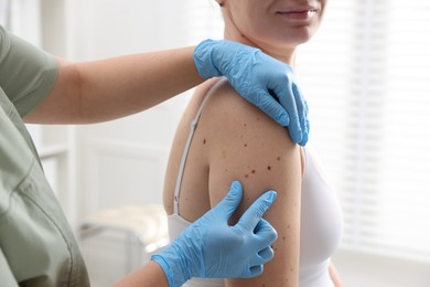 Photo of Doctor examining woman's moles in hospital, closeup