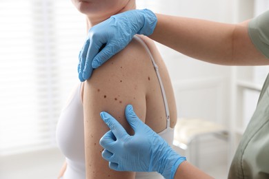 Photo of Doctor examining woman's moles in hospital, closeup