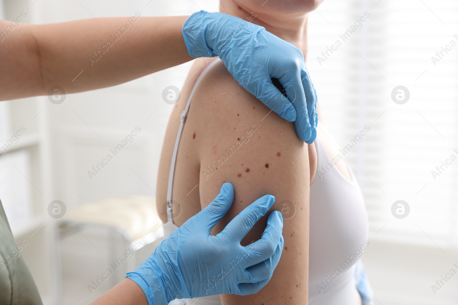 Photo of Doctor examining woman's moles in hospital, closeup