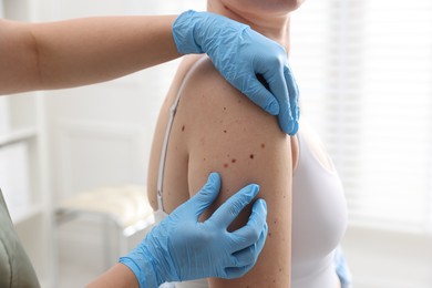 Photo of Doctor examining woman's moles in hospital, closeup