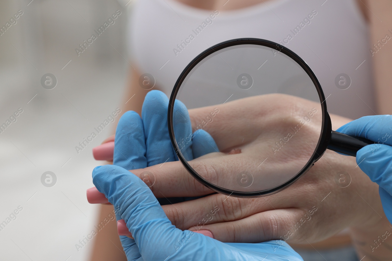 Photo of Doctor examining woman's moles in hospital, closeup