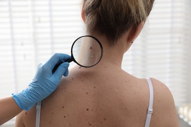 Photo of Doctor examining woman's moles in hospital, closeup